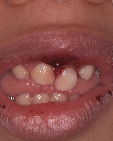 حوادث الأسنان عند الأطفال